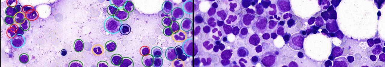Cancilico Raises €2.5M to Scale AI-Powered Bone Marrow Diagnostics
